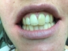 zirc crown before.jpg